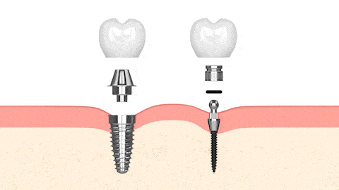 Mini Implantes Dentales en Emeryville, CA | Dra. Rose Magno