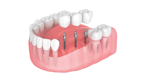 Puentes Dentales en Emeryville, CA | Dr. Rose Magno
