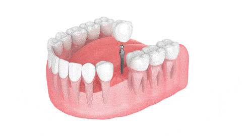 Implantes Dentales el Mismo Dia en Emeryville, CA | Dr. Rose Magno