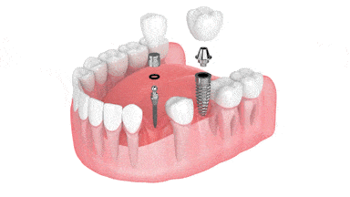 Dental Implants in Emeryville, CA | Dr. Rose Magno