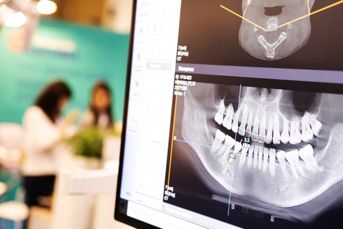 Digital X-rays in Emeryville, CA | Dr. Rose Magno