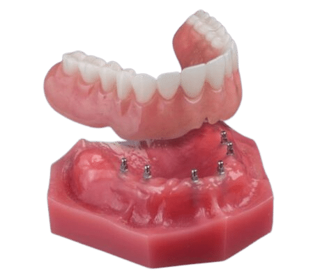 Dentaduras Snap-In en Emeryville, CA | Programar una consulta