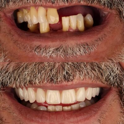 Mini Implantes en Emeryville, CA | Reserve una consulta | Dr. Magno