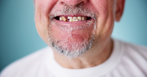 Dientes Faltantes en Emeryville, CA | Reserve una Consulta | Dr. Magno