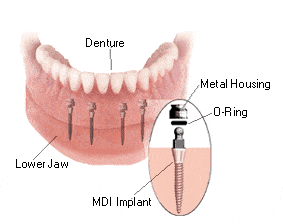Implant Dentistry in Emeryville, CA | Restore Your Smile Today!