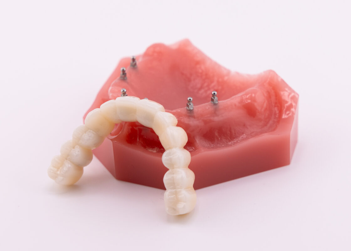 Full Mouth Dental Implants in Emeryville, CA | Fix-on-Six