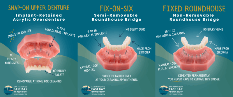 Denture Replacement in Emeryville, CA | Mini Implant Dentures