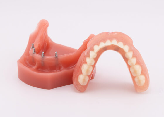 Denture Stabilization in San Francisco, CA | Affordable Implants 🦷