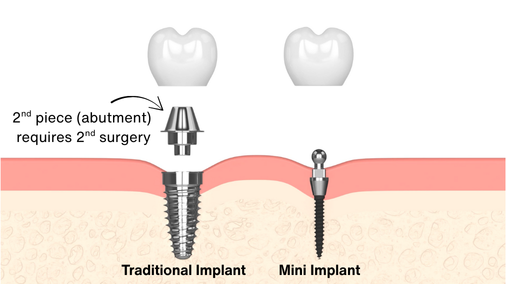 Mini Implantes Dentales en Emeryville, CA | Dra. Rose Magno