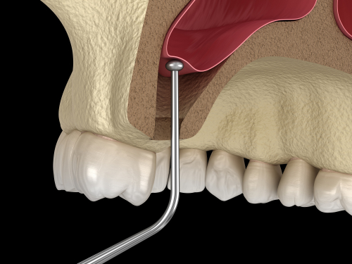Sinus Lift in San Francisco, CA | Affordable Sinus Lifts and Implants