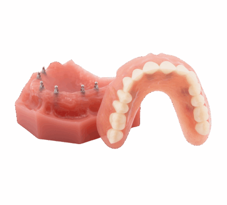 Snap-On Bridge in Emeryville, CA | Affordable Mini Dental Implants