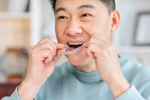 Clear Aligners in Emeryville, CA | Straighten Your Smile Affordably