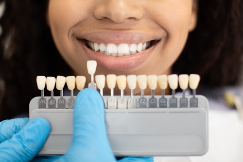 Veneers | Cosmetic Dentistry in San Francisco | Dr. Rose Magno