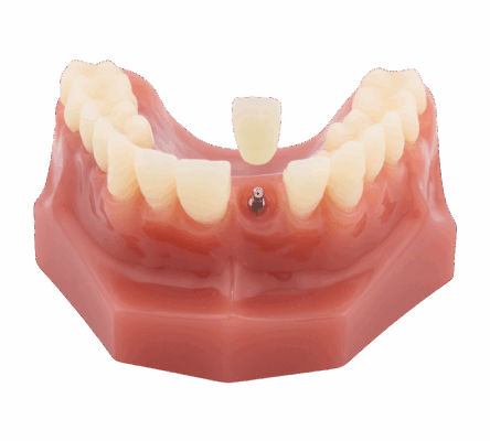 Procedimiento de Mini Implantes en San Francisco, CA | Affordable Implants