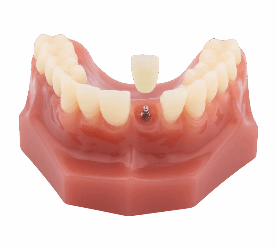 Mini Implant Procedure in San Francisco, CA | Affordable Implants