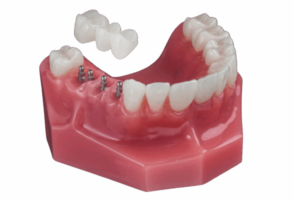 Dental Implant Financing in Emeryville, CA | Affordable Mini Implant