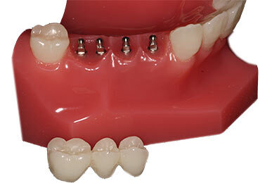 Dental Bridge in Emeryville, CA | Affordable Consultations