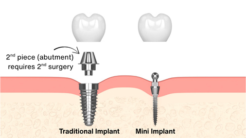 Mini-Dental-Implants-in-Emeryville-CA-Dr.-Rose-Magno