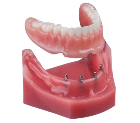 Denture Alternatives in Emeryville, CA | Mini Implants [Video Guide]