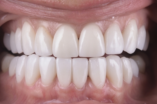 Porcelain Veneers in Emeryville, CA | Smile Consult [Video Q&A]