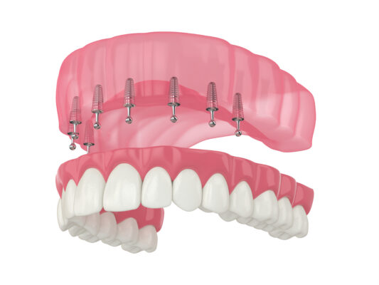¿Son los miniimplantes para dentaduras postizas la opción adecuada para usted? [Preguntas y respuestas en video]