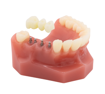 Dental Bridges vs. Partial Dentures in Emeryville [Video Guide]