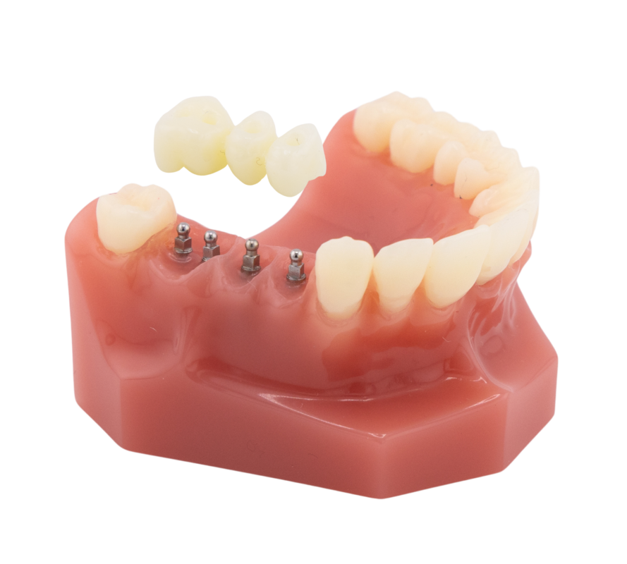 Dental Bridges vs. Partial Dentures in Emeryville [Video Guide]
