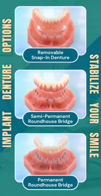 Prótesis dentales sobre implantes a precios accesibles en Emeryville | Consultas sobre implantes