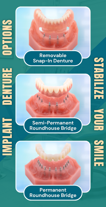 Prótesis dentales sobre implantes a precios accesibles en Emeryville | Consultas sobre implantes