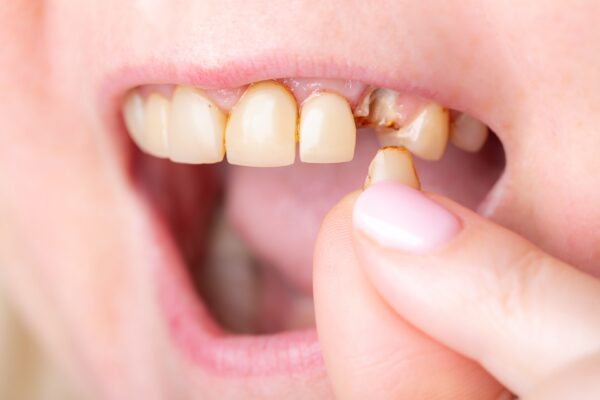 Broken Tooth in East Bay Area | Urgent Dental Care [Video Inside]