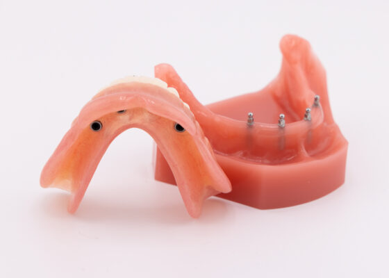 Prótesis dentales completas en Emeryville, California | Consulta sobre miniimplantes [Preguntas y respuestas en video]