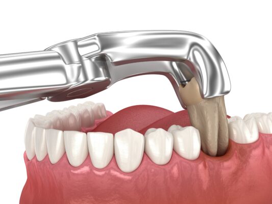 Teeth in a Day in Emeryville, CA | Same-Day Implants [Video Q&A]