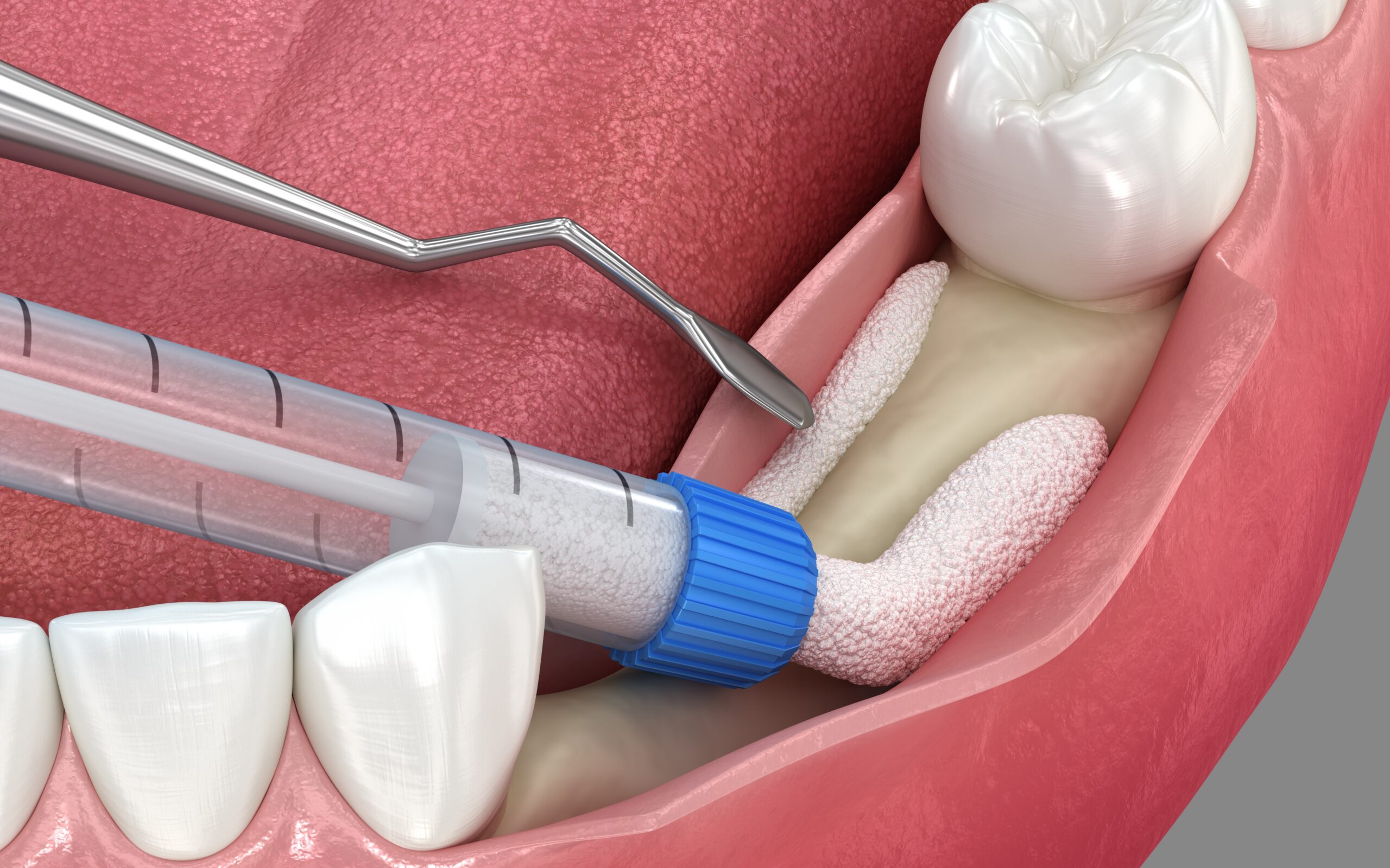 Injerto óseo dental en Emeryville, California | Miniimplantes [Preguntas y respuestas en video]