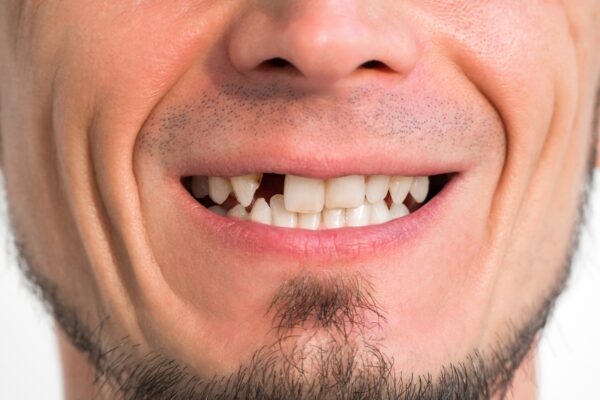 Knocked-Out Tooth in Emeryville, CA | Call for Emergency Dentistry