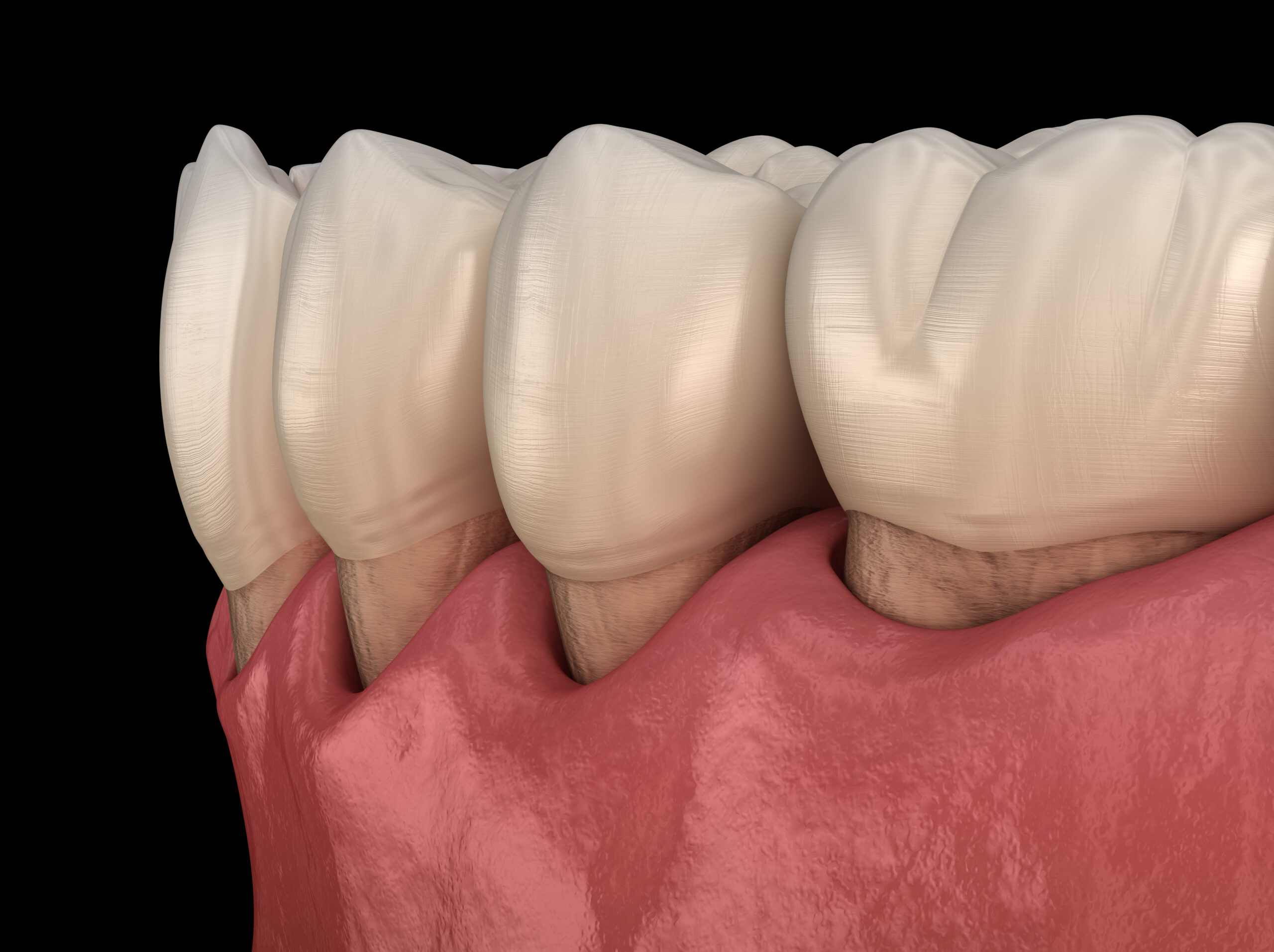 Gum Recession in Emeryville, CA | Treat Periodontitis [Video Q&A]